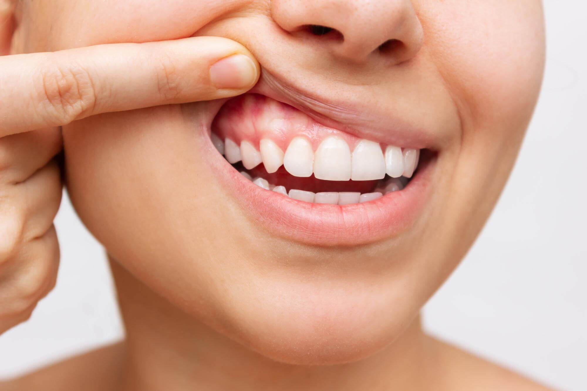 Gum Reshaping