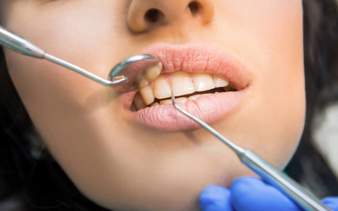 What Is Gum Flap Surgery?