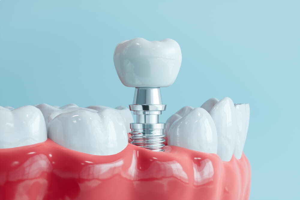Dental Implants