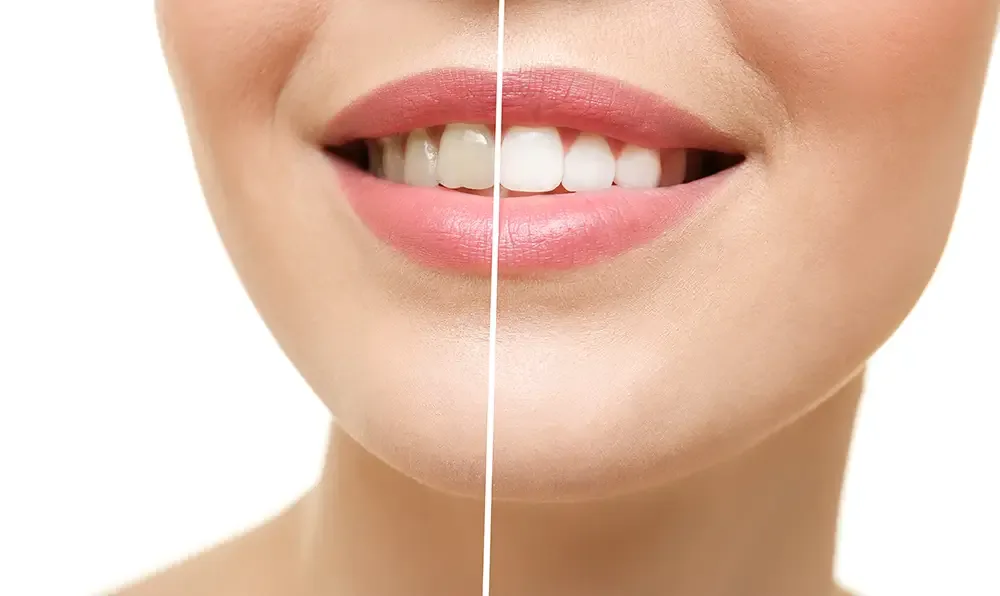 Teeth whitening before and after