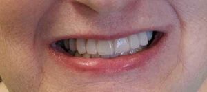 Patient After Photo