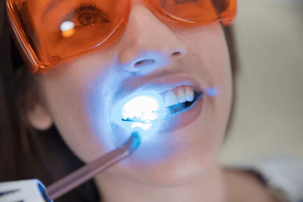 Tooth Fillings