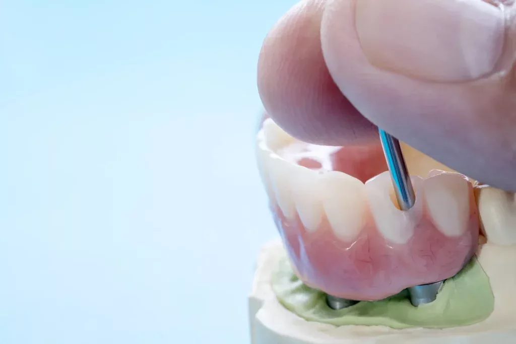 Dental Implants